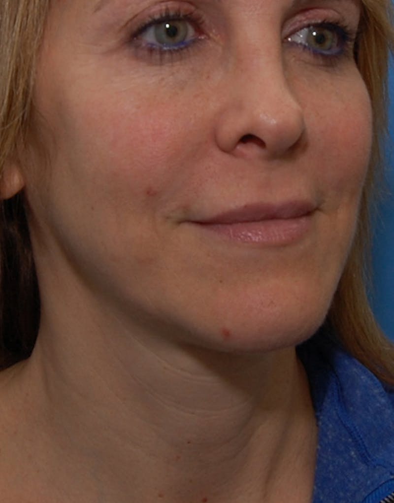 FaceTite Before & After Gallery - Patient 417816 - Image 5