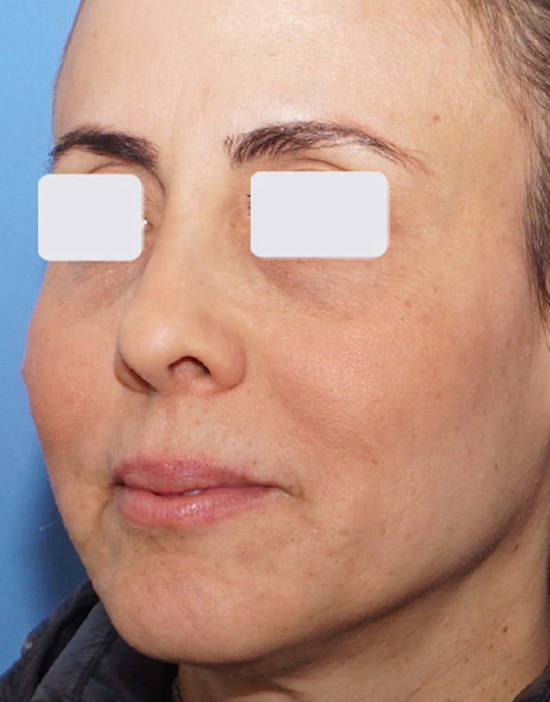 BOTOX Before & After Gallery - Patient 841254 - Image 2