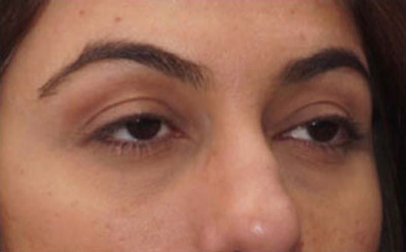 Fillers Before & After Gallery - Patient 214234 - Image 4