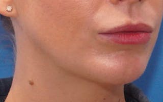 Chin Surgery Before & After Gallery - Patient 751069 - Image 2