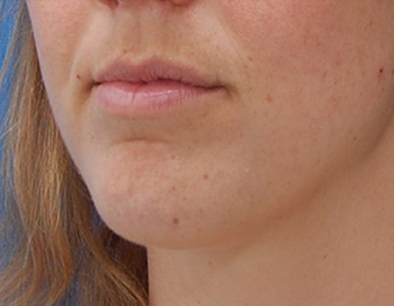 Kybella Before & After Gallery - Patient 426266 - Image 8