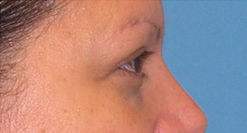 Eyelid Surgery Before & After Gallery - Patient 639891 - Image 6