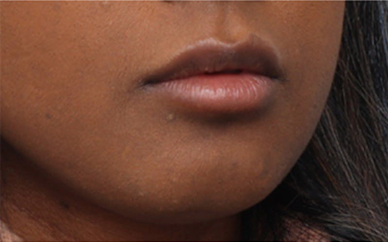 Lip Fillers Before & After Gallery - Patient 192837 - Image 3
