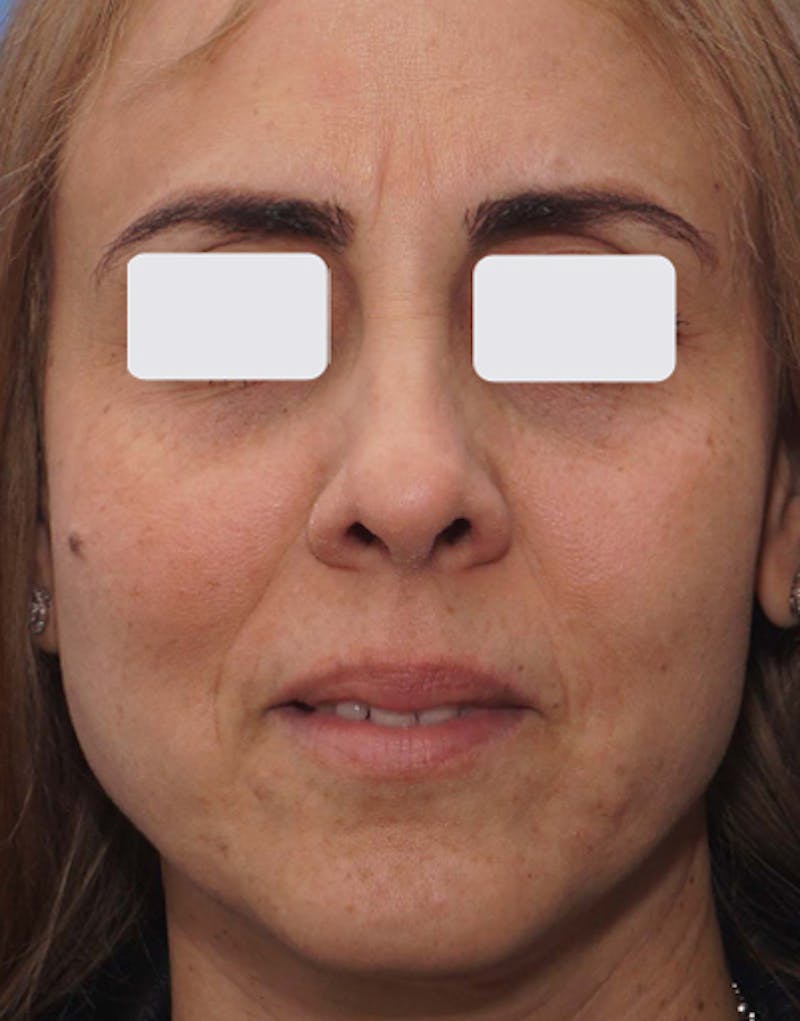 BOTOX Before & After Gallery - Patient 841254 - Image 3