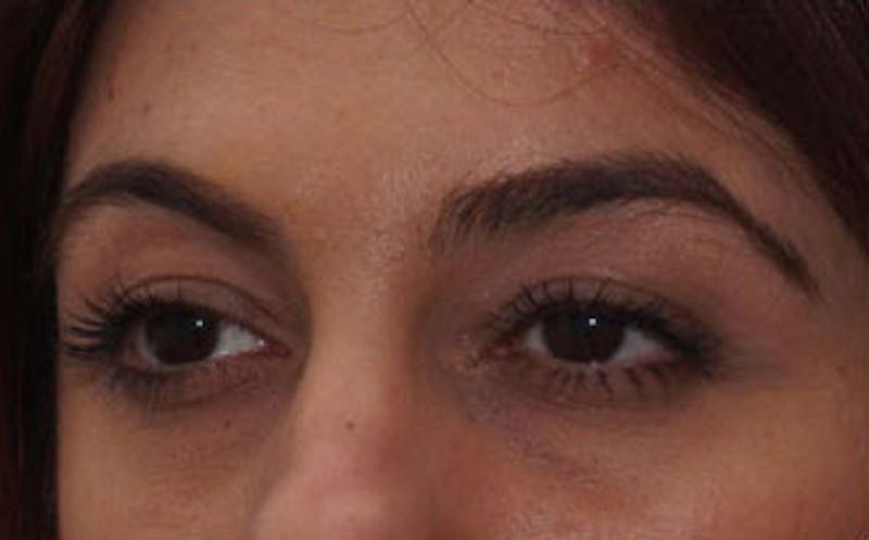 Fillers Before & After Gallery - Patient 214234 - Image 5