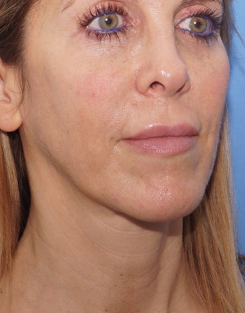 FaceTite Before & After Gallery - Patient 417816 - Image 6