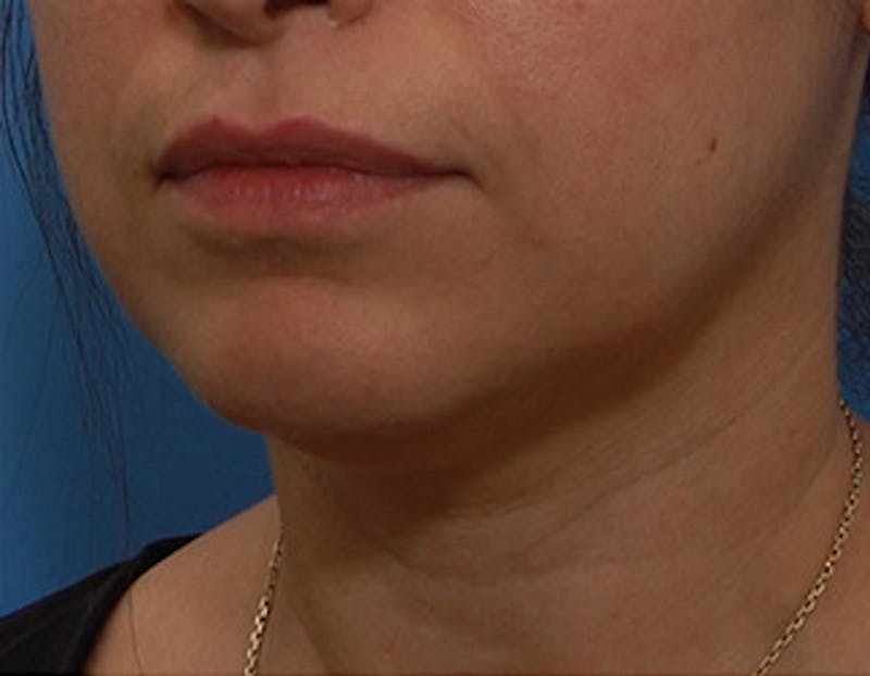 Kybella Before & After Gallery - Patient 302047 - Image 1