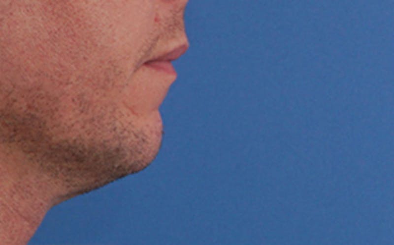 Chin Surgery Before & After Gallery - Patient 425140 - Image 1