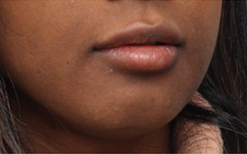 Lip Fillers Before & After Gallery - Patient 192837 - Image 4