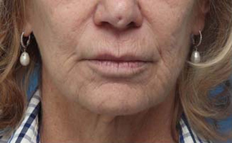 Dermabrasion Before & After Gallery - Patient 384622 - Image 1