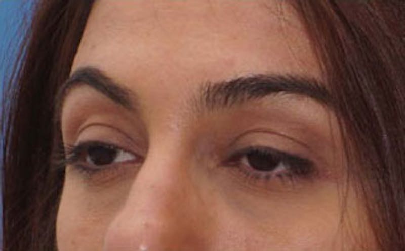 Fillers Before & After Gallery - Patient 214234 - Image 6