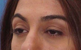 Fillers Before & After Gallery - Patient 214234 - Image 6