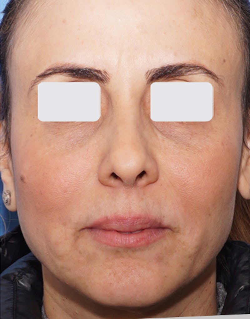 BOTOX Before & After Gallery - Patient 841254 - Image 4