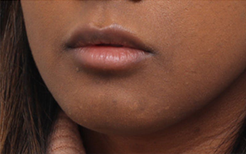 Lip Fillers Before & After Gallery - Patient 192837 - Image 5