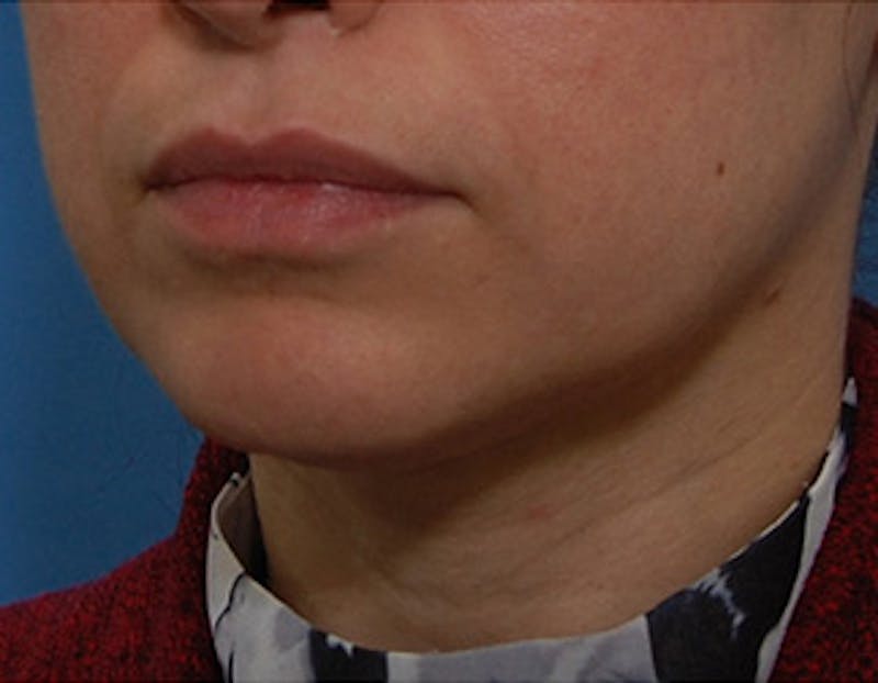 Kybella Before & After Gallery - Patient 302047 - Image 2