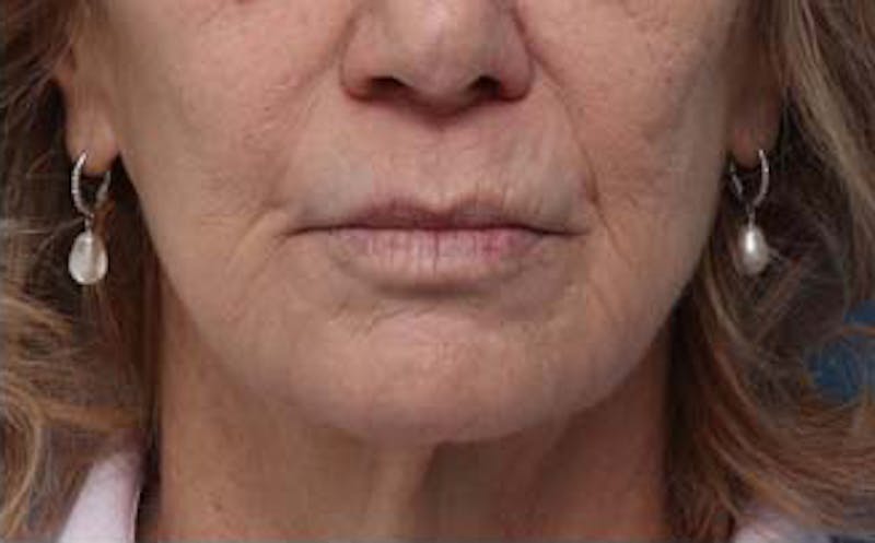 Dermabrasion Before & After Gallery - Patient 384622 - Image 2