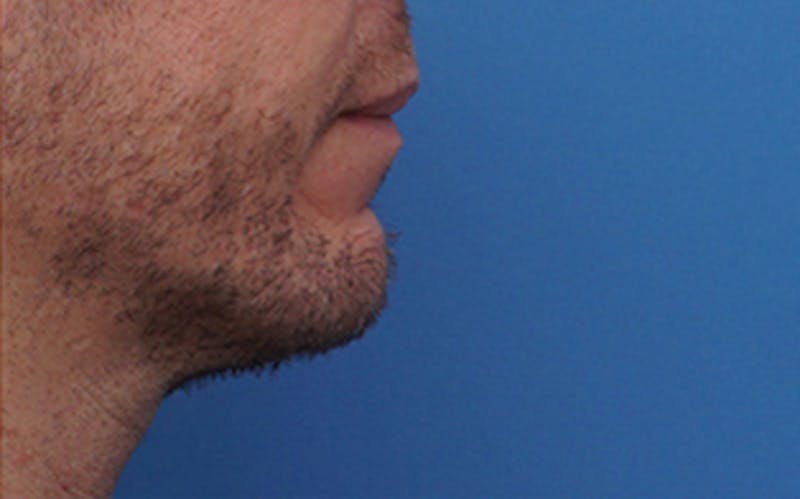 Chin Surgery Before & After Gallery - Patient 425140 - Image 2