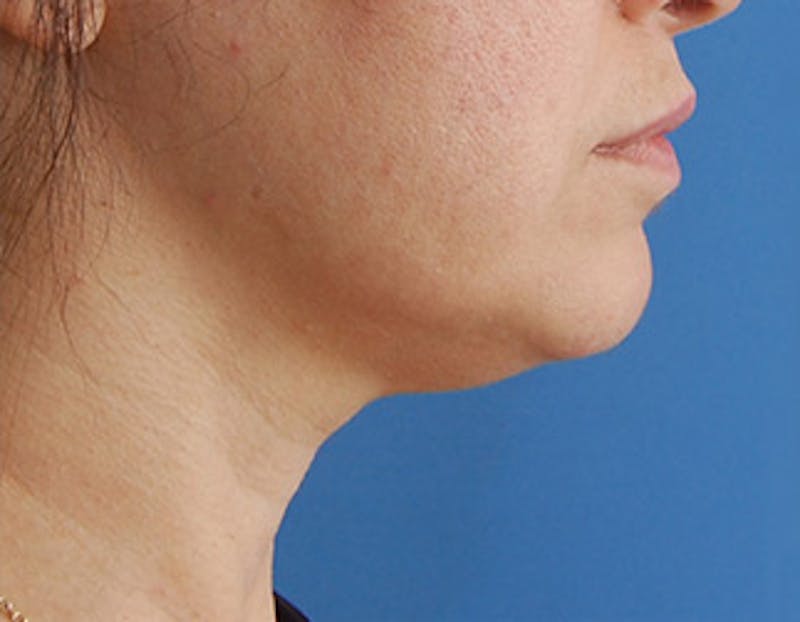 Kybella Before & After Gallery - Patient 302047 - Image 3