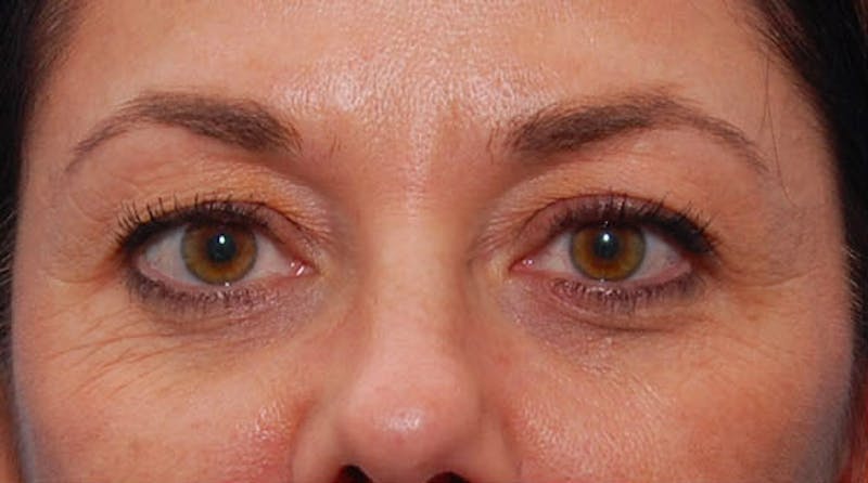 Patient T8CM_R7ySoONM0NZAAq9mA - Fillers Before & After Photos