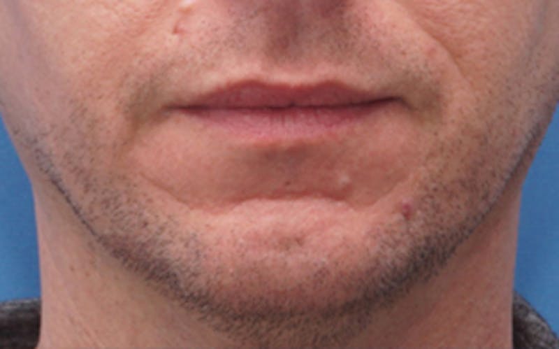 Chin Surgery Before & After Gallery - Patient 425140 - Image 3