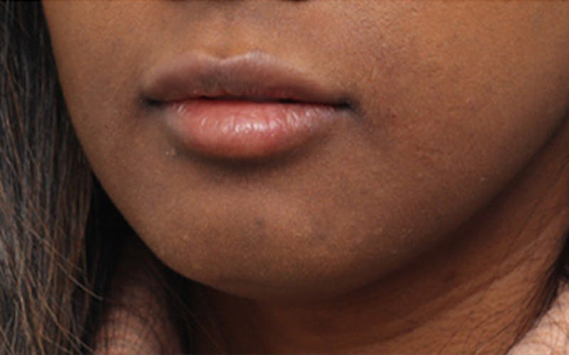 Lip Fillers Before & After Gallery - Patient 192837 - Image 6