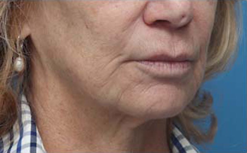Dermabrasion Before & After Gallery - Patient 384622 - Image 3