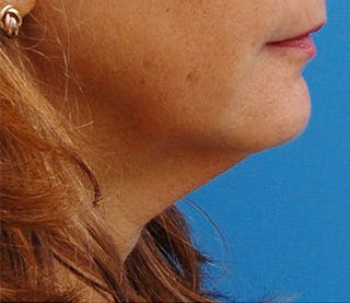 Fractora / Morpheus Before & After Gallery - Patient 221962 - Image 6