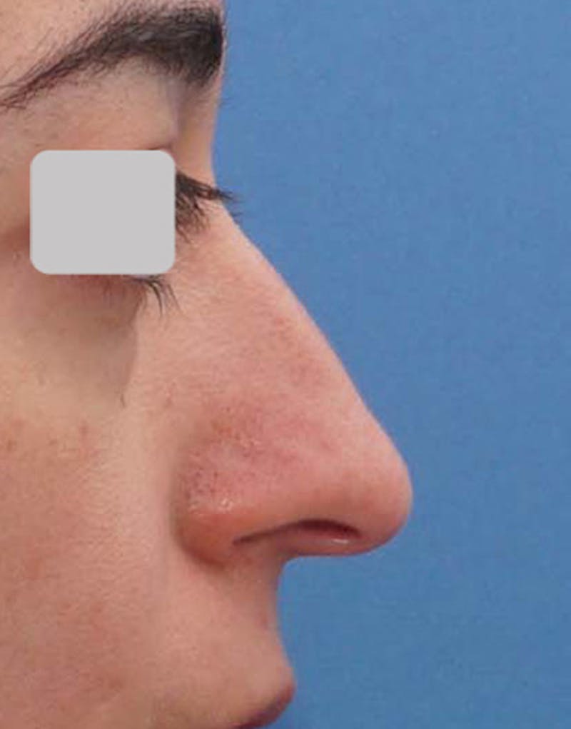 Rhinoplasty Before & After Gallery - Patient 183293 - Image 1
