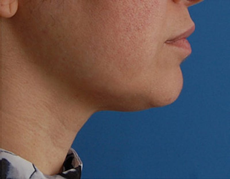 Kybella Before & After Gallery - Patient 302047 - Image 4