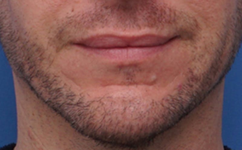 Chin Surgery Before & After Gallery - Patient 425140 - Image 4