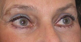 Eyelid Surgery Before & After Gallery - Patient 425624 - Image 4