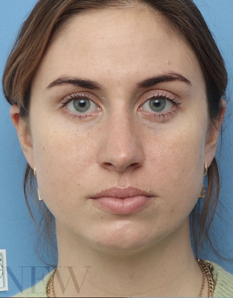 FaceTite Before & After Gallery - Patient 462550 - Image 1