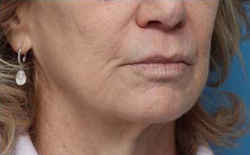 Dermabrasion Before & After Gallery - Patient 384622 - Image 4