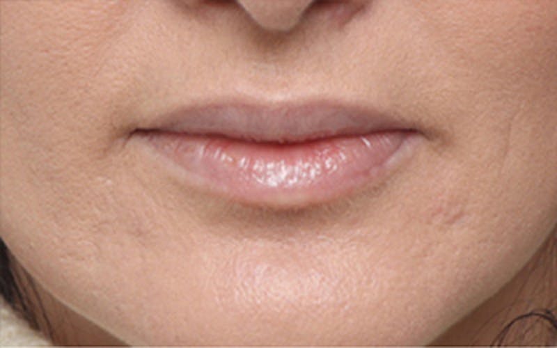 Lip Fillers Before & After Gallery - Patient 160802 - Image 1