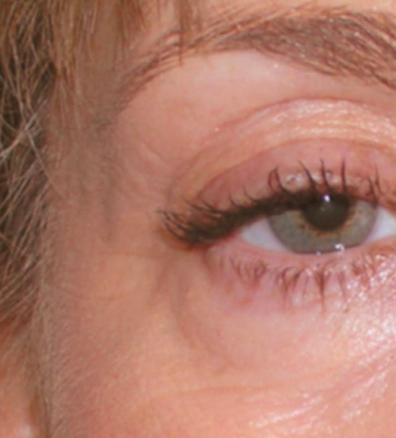 BOTOX Before & After Gallery - Patient 122084 - Image 2