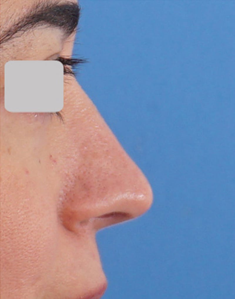 Rhinoplasty Before & After Gallery - Patient 183293 - Image 2