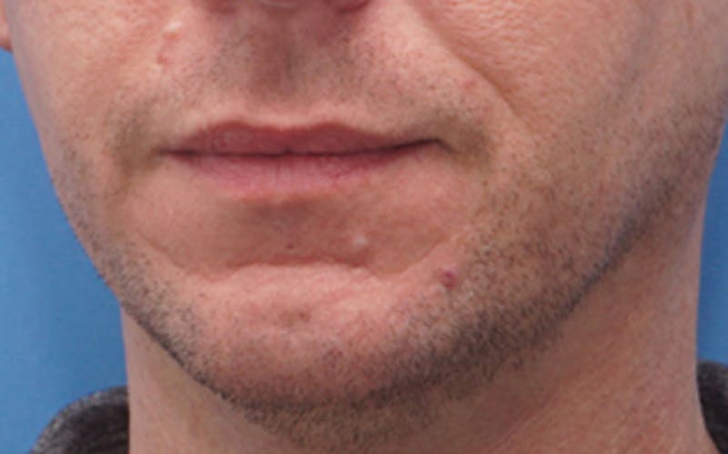 Chin Surgery Before & After Gallery - Patient 425140 - Image 5