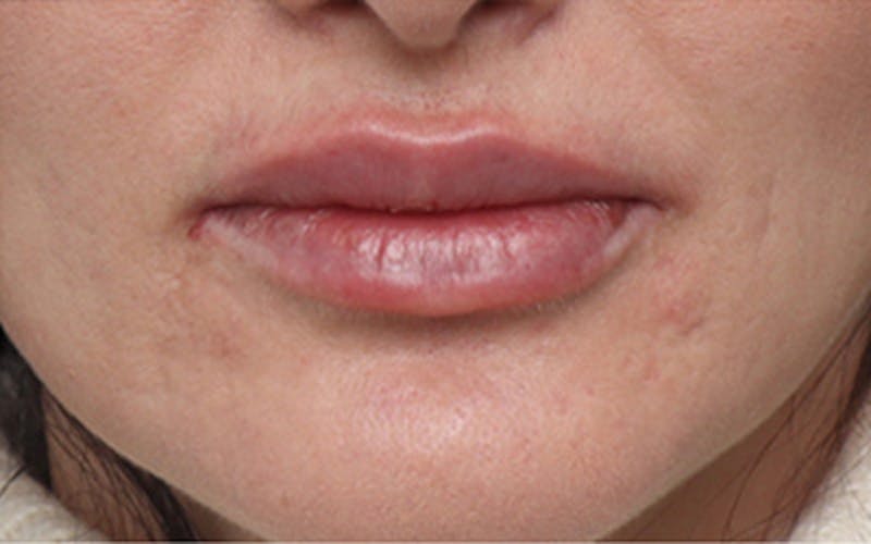 Lip Fillers Before & After Gallery - Patient 160802 - Image 2