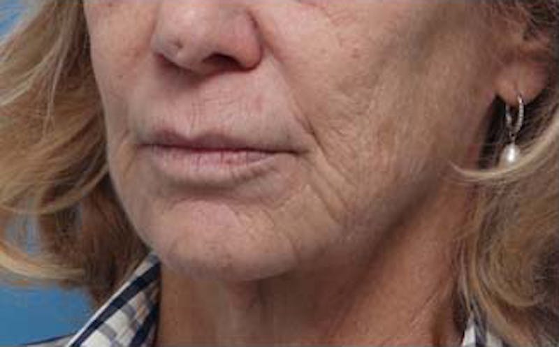 Dermabrasion Before & After Gallery - Patient 384622 - Image 5