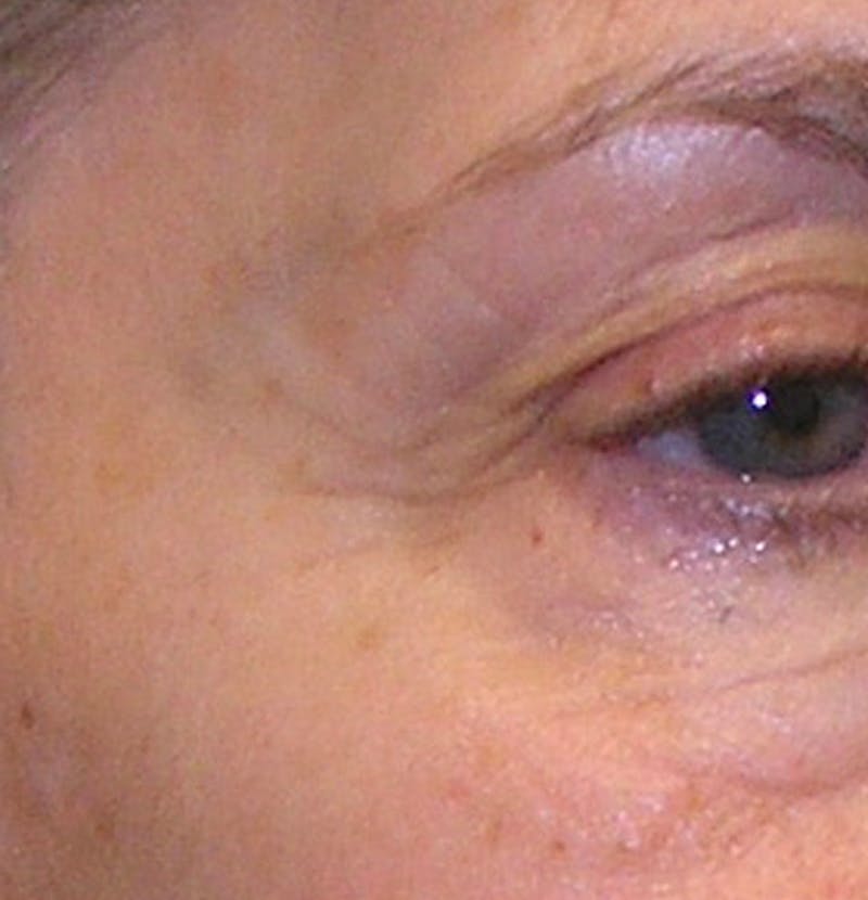 BOTOX Before & After Gallery - Patient 122084 - Image 3