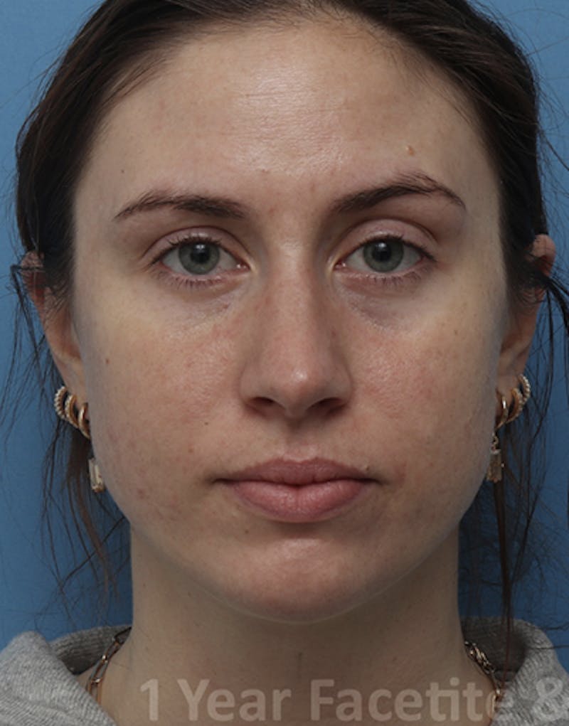 FaceTite Before & After Gallery - Patient 462550 - Image 2