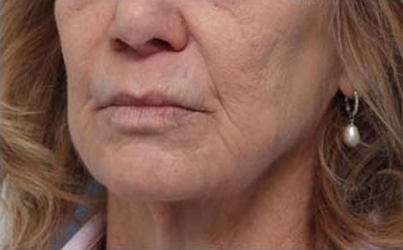Dermabrasion Before & After Gallery - Patient 384622 - Image 6
