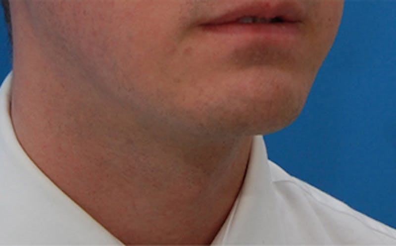 Kybella Before & After Gallery - Patient 127683 - Image 2