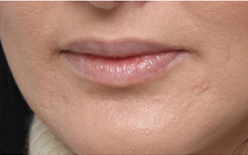 Lip Fillers Before & After Gallery - Patient 160802 - Image 3