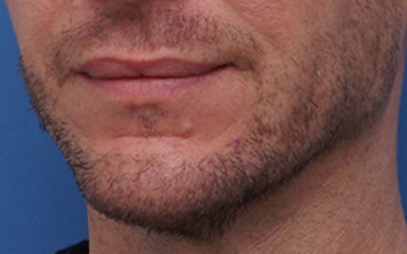 Chin Surgery Before & After Gallery - Patient 425140 - Image 6