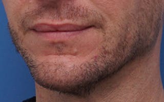 Chin Surgery Before & After Gallery - Patient 425140 - Image 6