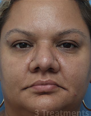 Fractora / Morpheus Before & After Gallery - Patient 154483 - Image 2