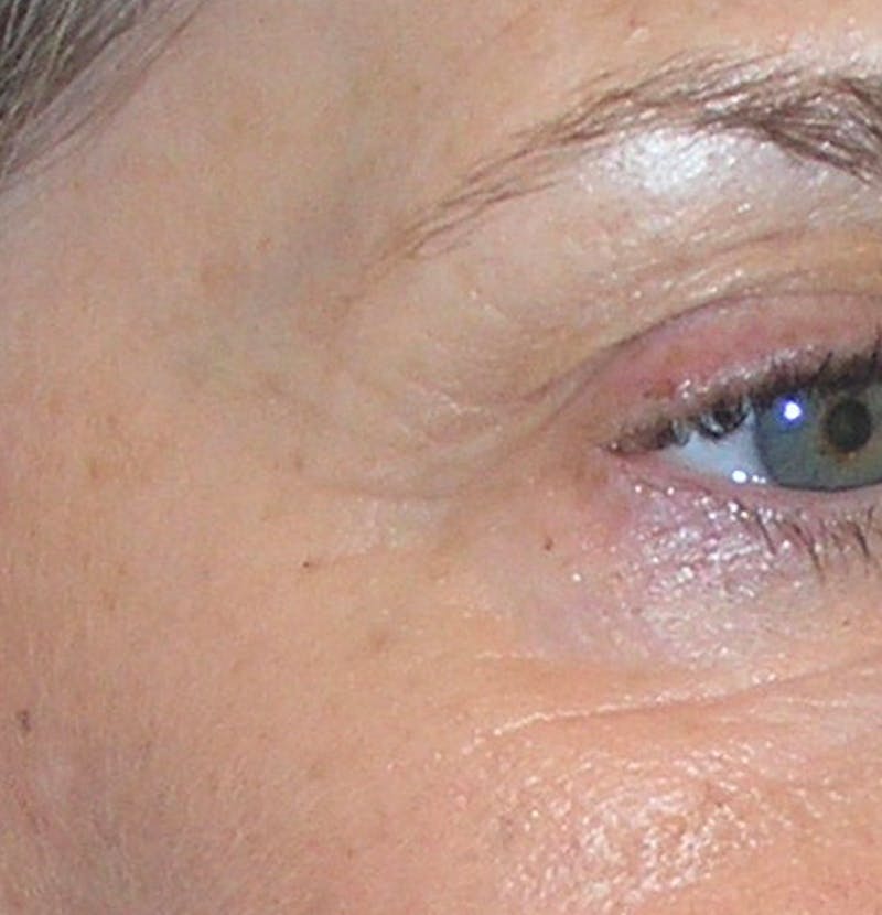 BOTOX Before & After Gallery - Patient 122084 - Image 4