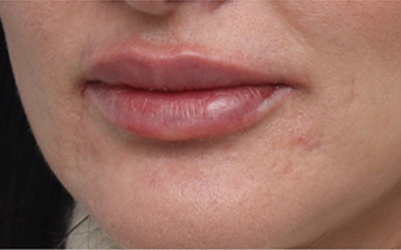 Lip Fillers Before & After Gallery - Patient 160802 - Image 4