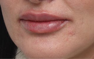 Lip Fillers Before & After Gallery - Patient 160802 - Image 4